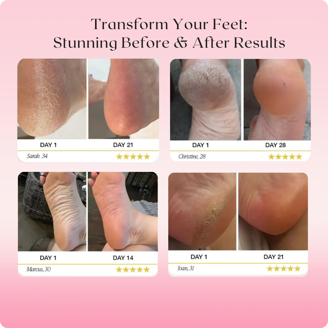 Novarci Callus Remover