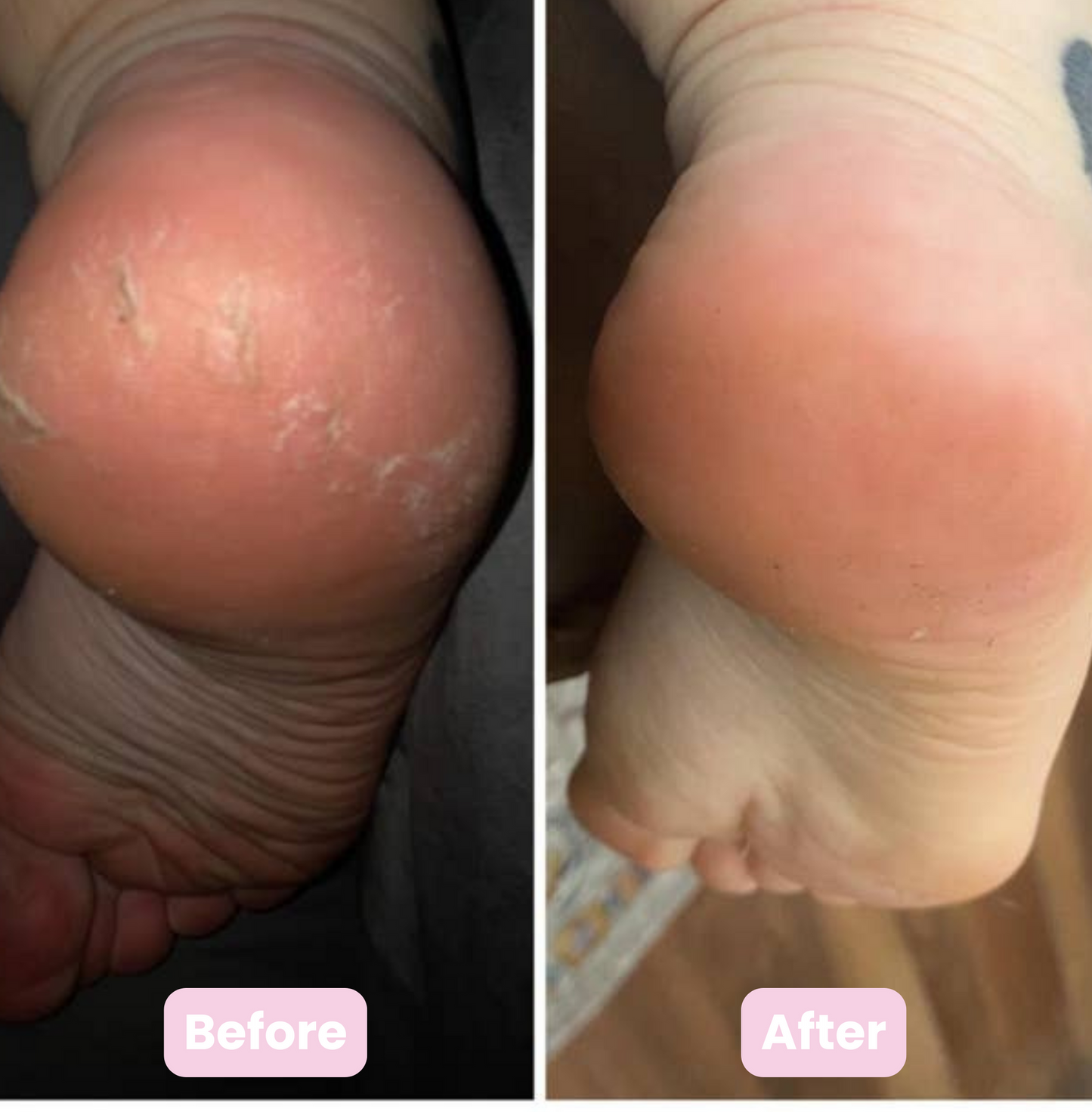 Novarci Callus Remover